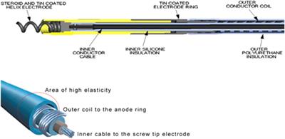 Transvenous lead extraction in conduction system pacing